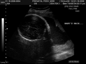 baby2007/2008-01-17_sonogram/BABY_1.JPG